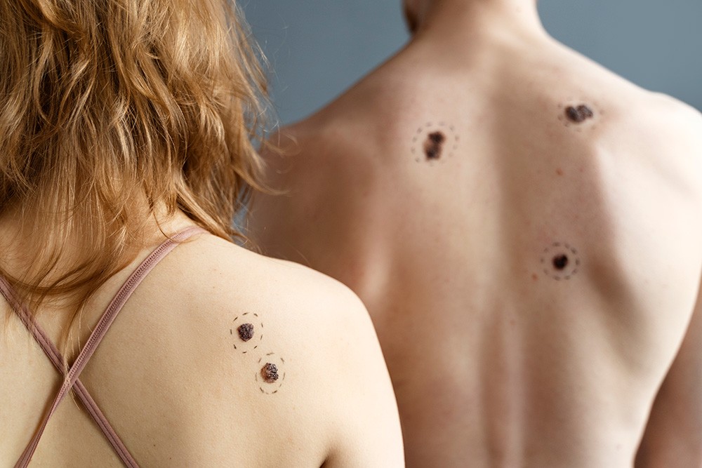 Dermatoscòpia a l'Atenció Primària